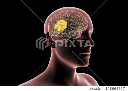 Brain mucormycosis, a brain lesion caused by fungi Mucor Brain mucormycosis, a brain lesion caused by fungi Mucor 128664567
