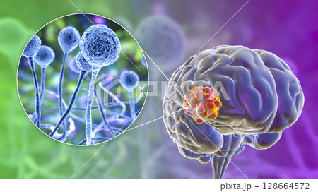 Brain mucormycosis, a brain lesion caused by fungi Mucor, also known as black fungus, with close-up view of the fungi, 3D illustration Brain mucormycosis, a brain lesion caused by fungi Mucor, also known as black fungus, with close-up view of the fungi, 3D illustration 128664572