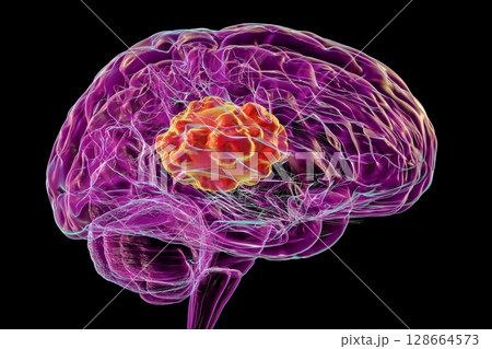 Brain mucormycosis, a brain lesion caused by fungi Mucor, also known as black fungus 128664573