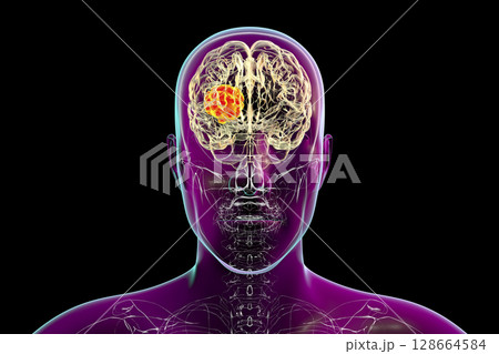 Brain mucormycosis, a brain lesion caused by fungi Mucor, also known as black fungus 128664584