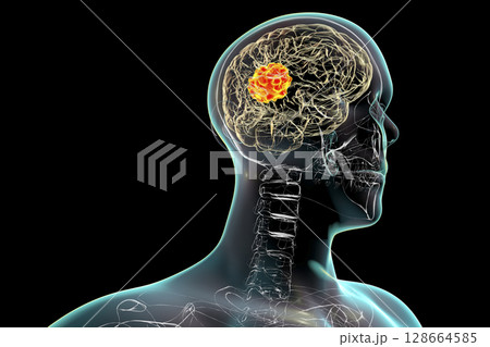 Brain mucormycosis, a brain lesion caused by fungi Mucor, also known as black fungus Brain mucormycosis, a brain lesion caused by fungi Mucor, also known as black fungus 128664585
