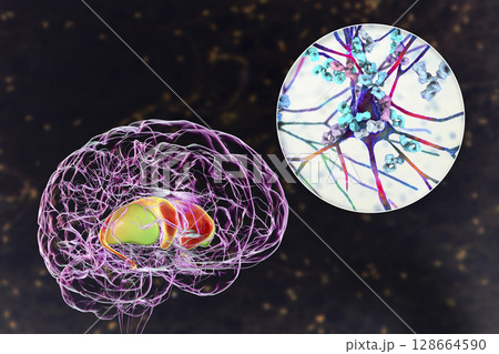 Anti-basal ganglia antibodies. 3D conceptual illustration 128664590