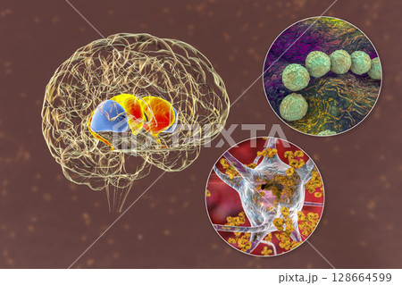 Brain disease due to streptococcal infection and anti-basal ganglia antibodies, 3D conceptual illustration Brain disease due to streptococcal infection and anti-basal ganglia antibodies, 3D conceptual illustration 128664599