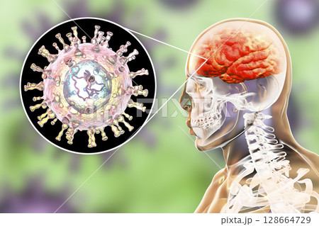 Varicella zoster virus encephalitis Varicella zoster virus encephalitis 128664729