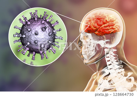 Varicella zoster virus encephalitis Varicella zoster virus encephalitis 128664730