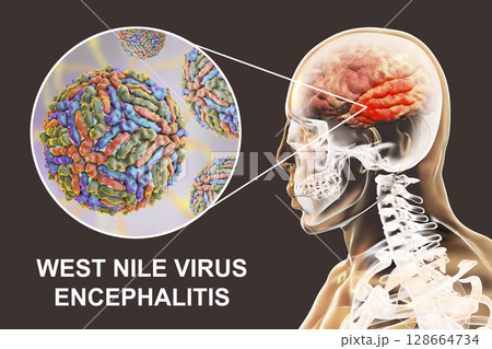West Nile virus encephalitis West Nile virus encephalitis 128664734