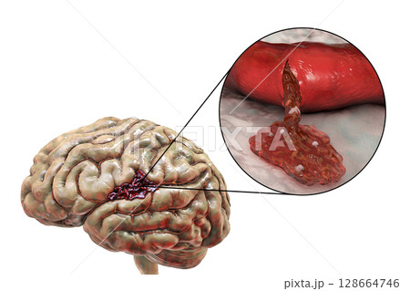 Hemorrhagic stroke, illustration Hemorrhagic stroke, illustration 128664746