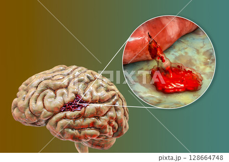 Hemorrhagic stroke, illustration Hemorrhagic stroke, illustration 128664748