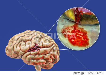 Hemorrhagic stroke, illustration Hemorrhagic stroke, illustration 128664749