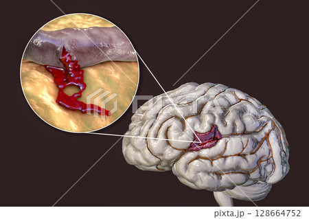 Hemorrhagic stroke, illustration Hemorrhagic stroke, illustration 128664752