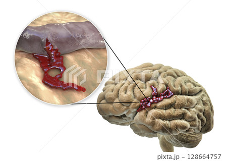 Hemorrhagic stroke, illustration Hemorrhagic stroke, illustration 128664757