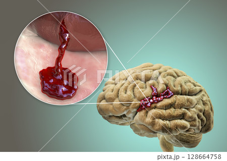 Hemorrhagic stroke, illustration 128664758