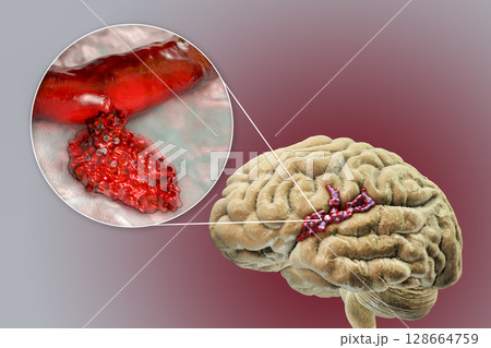 Hemorrhagic stroke, illustration 128664759