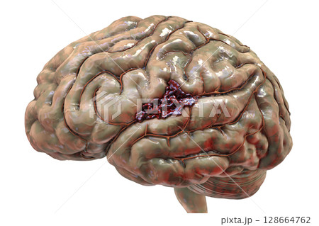 Hemorrhagic stroke, illustration 128664762