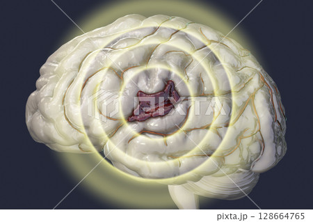 Hemorrhagic stroke, illustration 128664765
