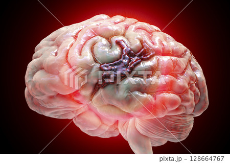Hemorrhagic stroke, illustration 128664767