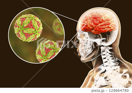 Japanese B encephalitis, medical concept Japanese B encephalitis, medical concept 128664780