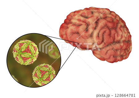 Japanese B encephalitis, medical concept Japanese B encephalitis, medical concept 128664781