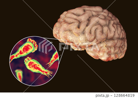Brain-eating amoeba infection, naegleriasis Brain-eating amoeba infection, naegleriasis 128664819