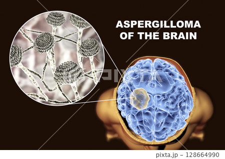 Aspergilloma of the brain and close-up view of fungi Aspergillus 128664990