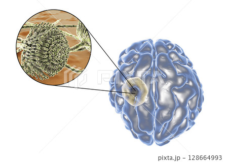 Aspergilloma of the brain and close-up view of fungi Aspergillus Aspergilloma of the brain and close-up view of fungi Aspergillus 128664993