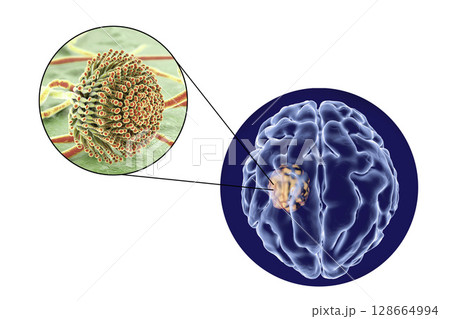 Aspergilloma of the brain and close-up view of fungi Aspergillus 128664994