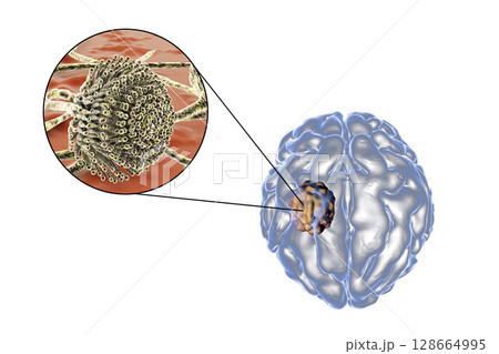 Aspergilloma of the brain and close-up view of fungi Aspergillus 128664995