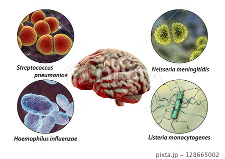 Etiology of bacterial meningitis Etiology of bacterial meningitis 128665002