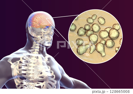 Cryptococcal meningitis, medical concept 128665008
