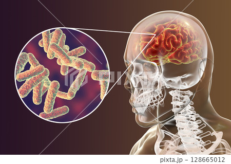 Bacterial brain infection medical concept, meningitis, encephalitis Bacterial brain infection medical concept, meningitis, encephalitis 128665012