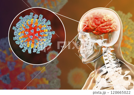 Measles-induced encephalitis, medical concept Measles-induced encephalitis, medical concept 128665022