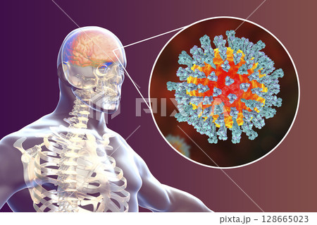 Measles-induced encephalitis, medical concept 128665023
