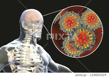 Measles-induced encephalitis, medical concept Measles-induced encephalitis, medical concept 128665024