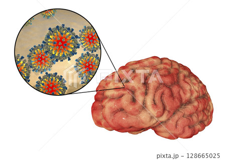 Measles-induced encephalitis, medical concept Measles-induced encephalitis, medical concept 128665025