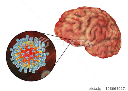 Measles-induced encephalitis, medical concept Measles-induced encephalitis, medical concept 128665027
