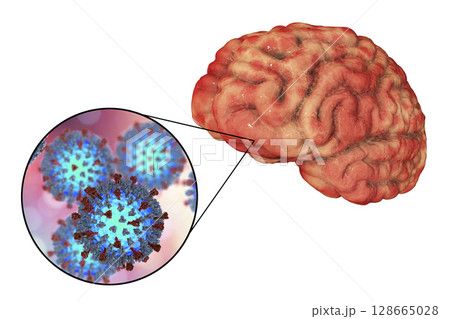 Measles-induced encephalitis, medical concept 128665028