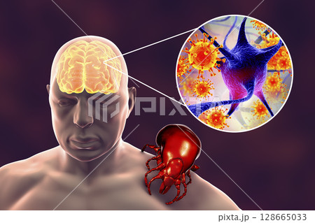 Tick-borne encephalitis concept 128665033