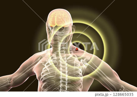 Tick-borne encephalitis concept Tick-borne encephalitis concept 128665035