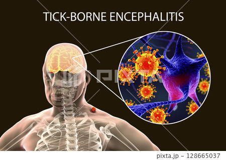 Tick-borne encephalitis concept 128665037