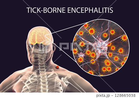 Tick-borne encephalitis concept 128665038