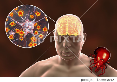 Tick-borne encephalitis concept 128665042