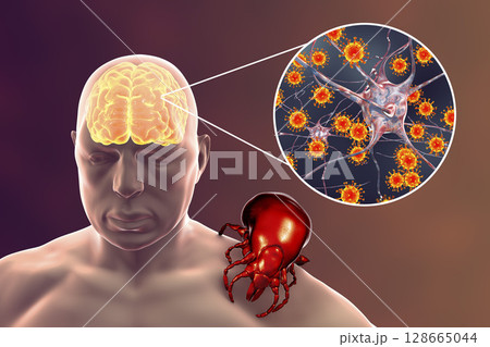 Tick-borne encephalitis concept 128665044