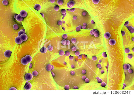 Spherical bacteria inside bone tissue Spherical bacteria inside bone tissue 128668247