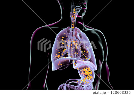 Aspiration pneumonia, 3D illustration 128668326