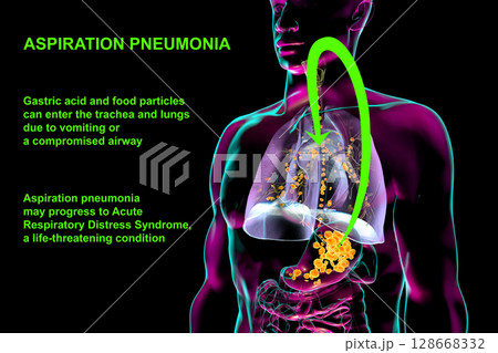 Aspiration pneumonia, 3D illustration 128668332