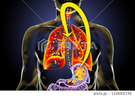 Aspiration pneumonia, 3D illustration 128668336