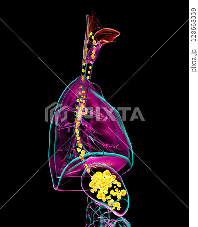 Aspiration pneumonia, 3D illustration Aspiration pneumonia, 3D illustration 128668339