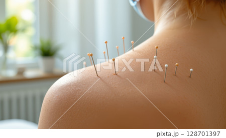 Acupuncture needles on skin, wellness therapy, relaxation, alternative medicine, healing, closeup view, natural treatment 128701397