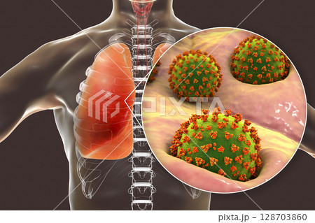 SARS-CoV-2 viruses in alveoli of human lungs causing COVID-19. Novel Coronavirus 128703860