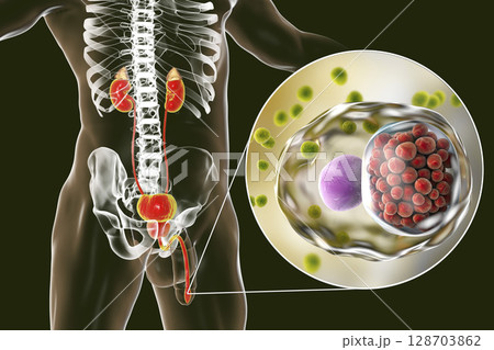 Chlamydiosis infection in man Chlamydiosis infection in man 128703862